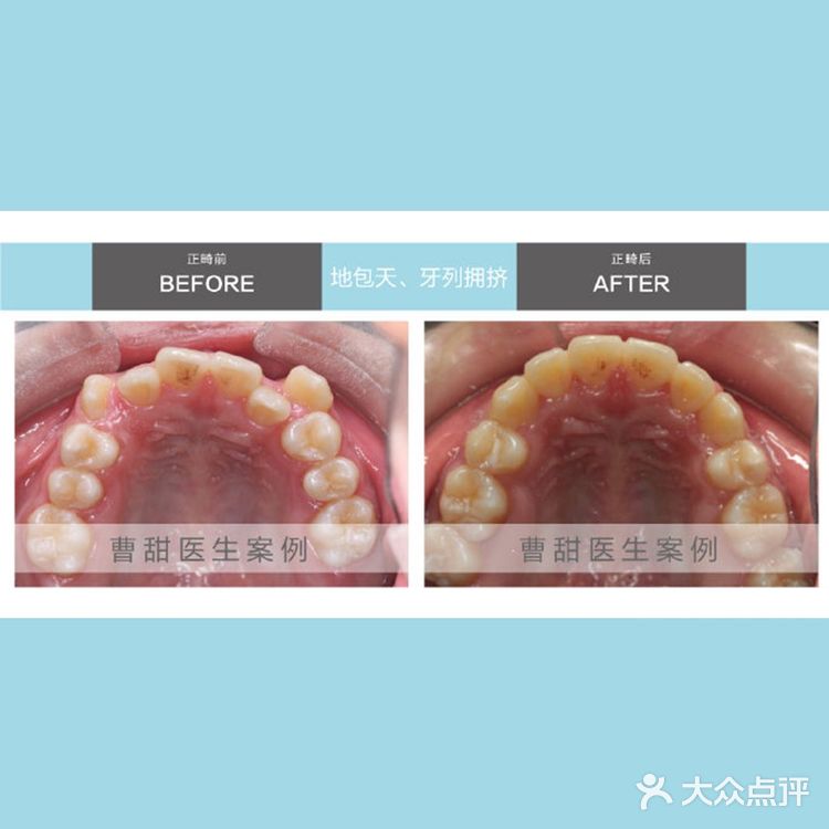 案例 地包天 反颌 矫正案例 8图对比 吃喝玩乐精选 大众点评移动版