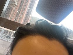 -碧莲盛·不剃发植发