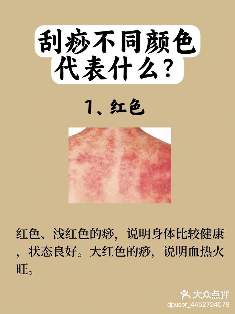 5月28日 13:53 关注 痧色解密 不同颜色的痧意味着什么🔬