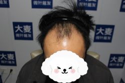 点击看大图 -大麦微针植发丨全国连锁