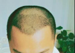 -大麦微针植发丨全国连锁