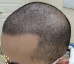 -大麦微针植发丨全国连锁