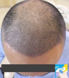 -大麦微针植发丨全国连锁