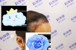 -大麦微针植发丨全国连锁