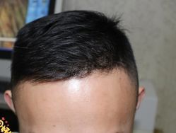 -大麦微针植发丨全国连锁