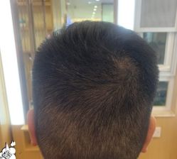 -大麦微针植发丨全国连锁