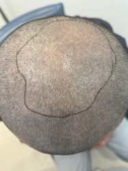 -大麦微针植发丨全国连锁