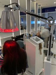 体验后-大麦微针植发全国连锁