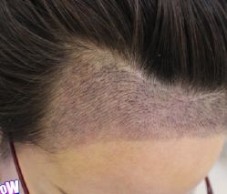 -大麦微针植发丨全国连锁