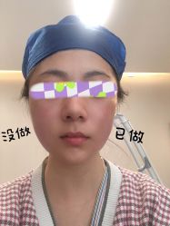 体验后-针美汇欧邦医疗美容