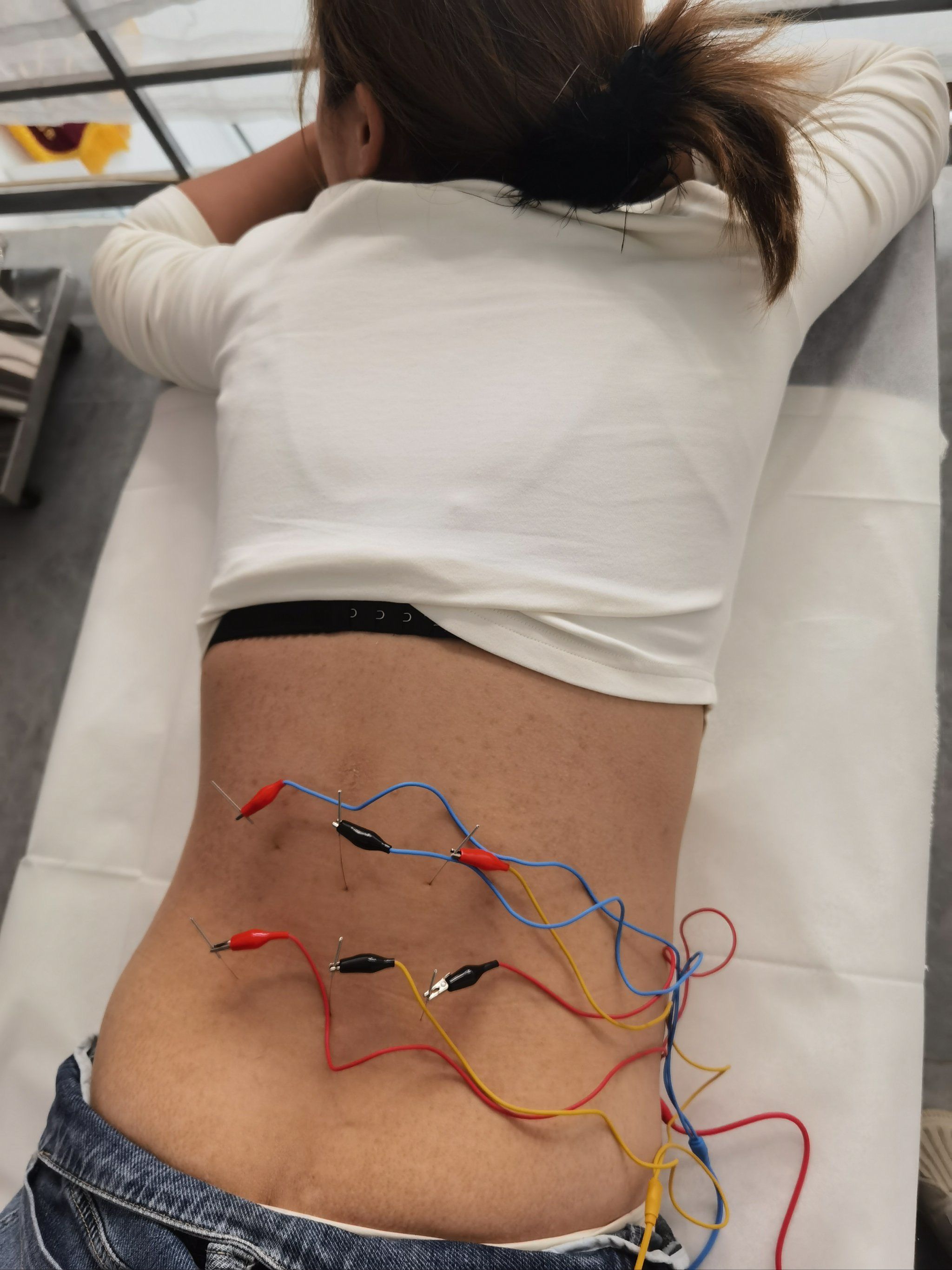 女孩腰痛2年,针灸是她乐意接受的治疗方式