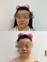 体验前-美安心医美·美迪迈黄金微针·美拉美医疗美容