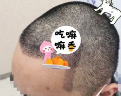 -大麦微针植发全国连锁