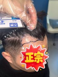 -大麦微针植发全国连锁