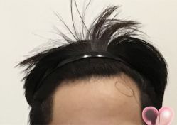 -大麦微针植发全国连锁