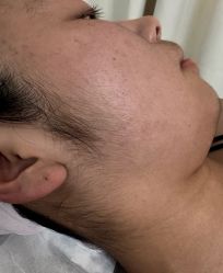 -薇兰专业脱毛连锁机构