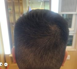 -大麦微针植发丨全国连锁