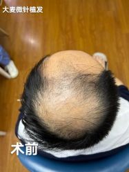 -大麦微针植发全国连锁