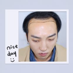 体验后-大麦微针植发全国连锁