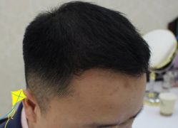 -大麦微针植发丨全国连锁