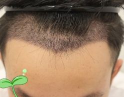 -大麦微针植发丨全国连锁