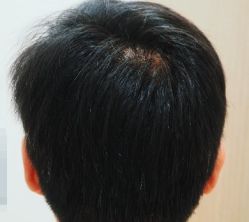 -大麦微针植发全国连锁
