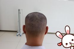 -大麦微针植发丨全国连锁