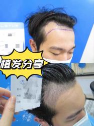 点击看大图 -碧莲盛·不剃发植发