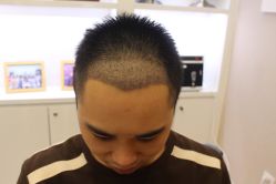 -大麦微针植发丨全国连锁