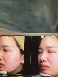-苑苑vbeauty科技美容SPA