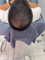 -大麦微针植发丨全国连锁
