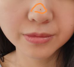 体验后-深圳春天阳光医院·轮廓抗衰中心