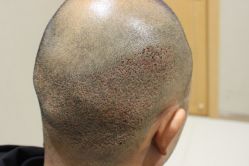 点击看大图 -大麦微针植发丨全国连锁