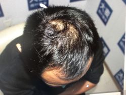 体验前-大麦微针植发丨全国连锁