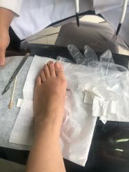 -德哥灰指甲脚气甲沟炎跖疣护理