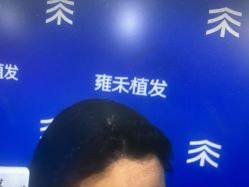 -雍禾植发全国连锁