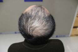 -大麦微针植发全国连锁