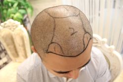 点击看大图 -大麦微针植发丨全国连锁