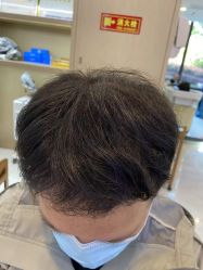 点击看大图 体验后-大麦微针植发丨全国连锁