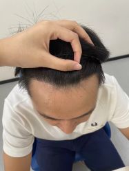 -大麦微针植发全国连锁