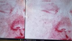 体验后-苑苑vbeauty科技美容SPA
