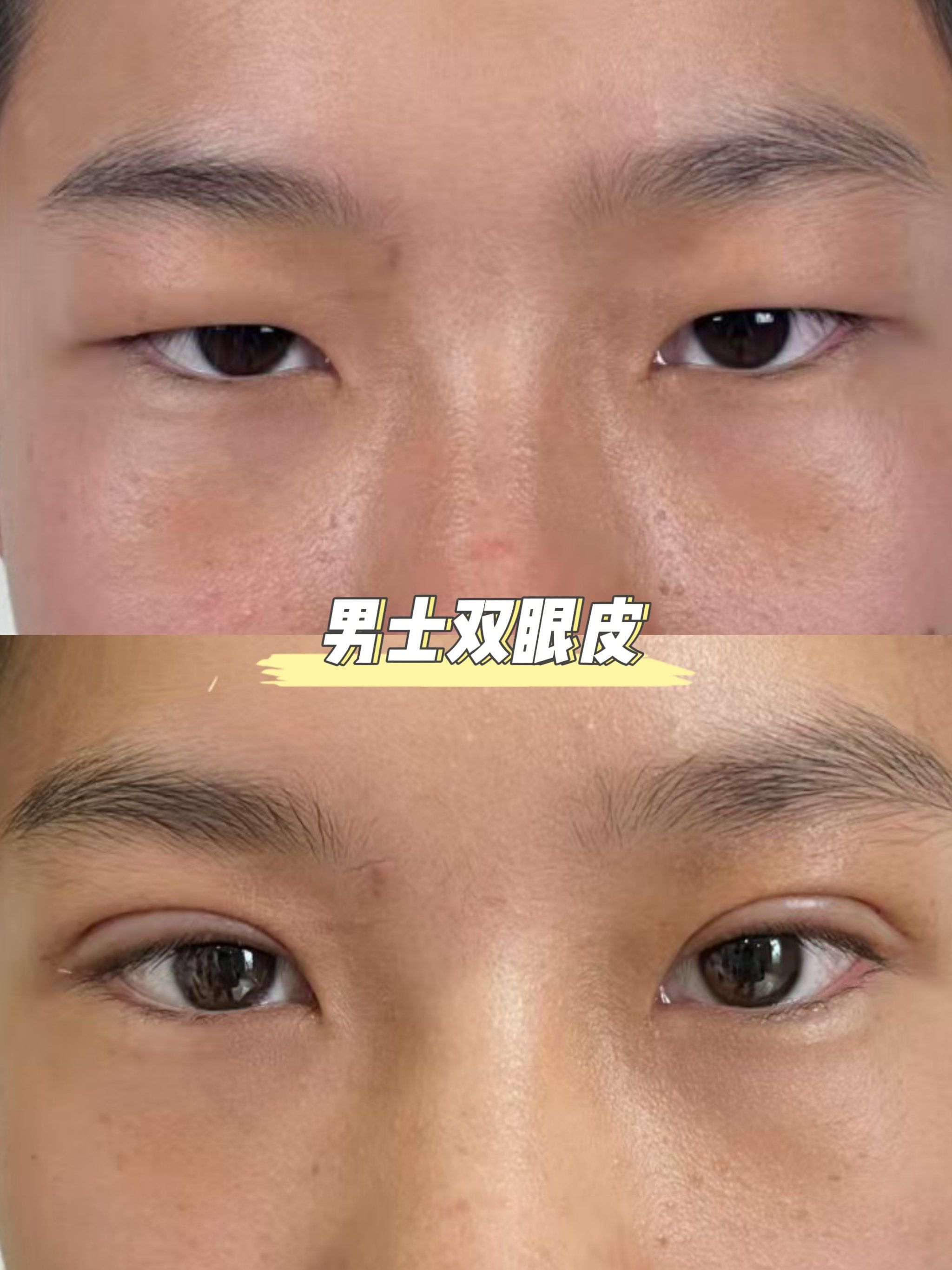 男士双眼皮厚度参考
