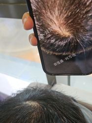 -碧莲盛·不剃发植发