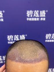 -碧莲盛·不剃发植发