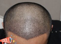 -大麦微针植发丨全国连锁