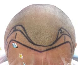 -大麦微针植发全国连锁