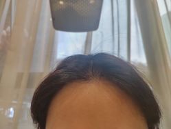 -碧莲盛·不剃发植发