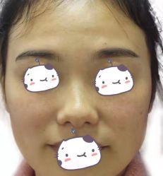 体验前-成都西区医院整形美容