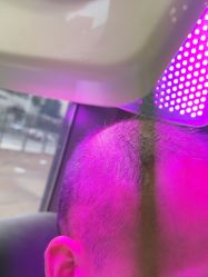 -碧莲盛·不剃发植发