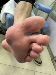-德哥灰指甲脚气甲沟炎跖疣护理